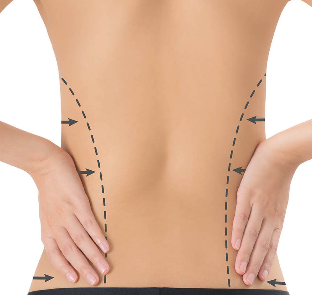 Diagram of where excess fat will be addressed with vaser liposuction on women's love handles