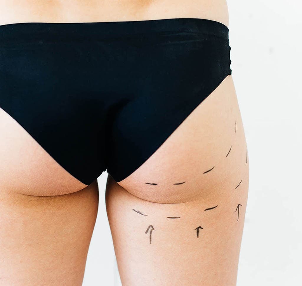 Example of where VASER liposuction can address excess fat in the buttocks