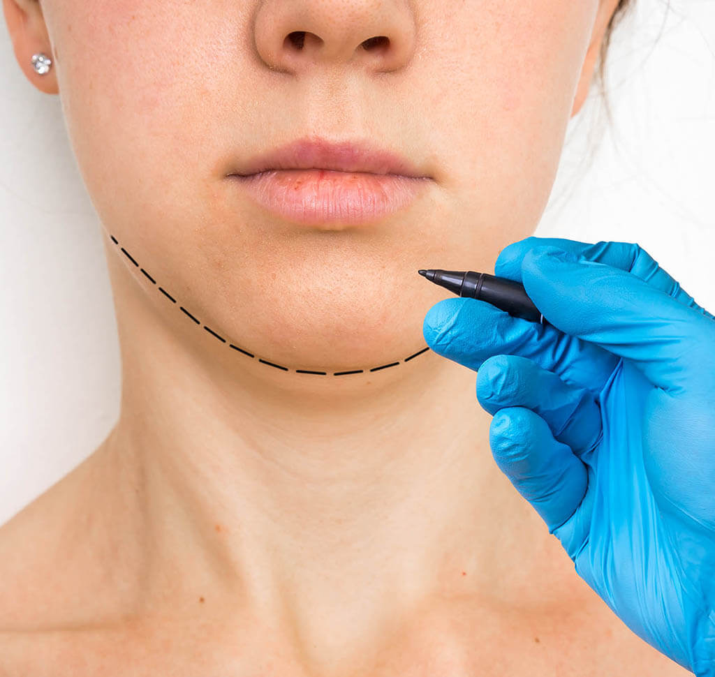 Example of where VASER lipo can address excess fat in the chin and neck area