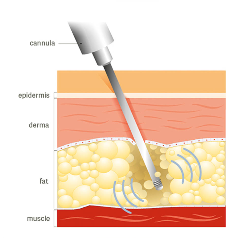 Diagram of how liposuction reaches fat