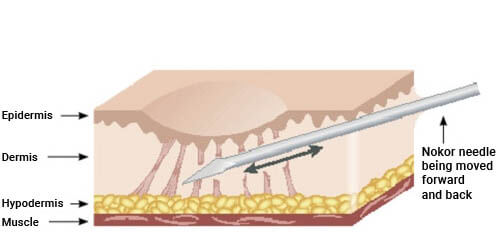 Diagram of how scar removal works