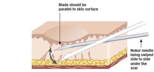 Illustration of how scar reduction works