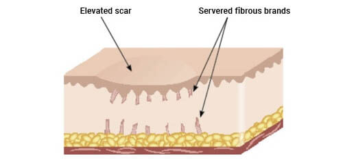 Illustration of scar reduction