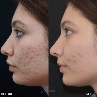 Acne Scars Before & After Gallery - Patient 20905116 - Image 1