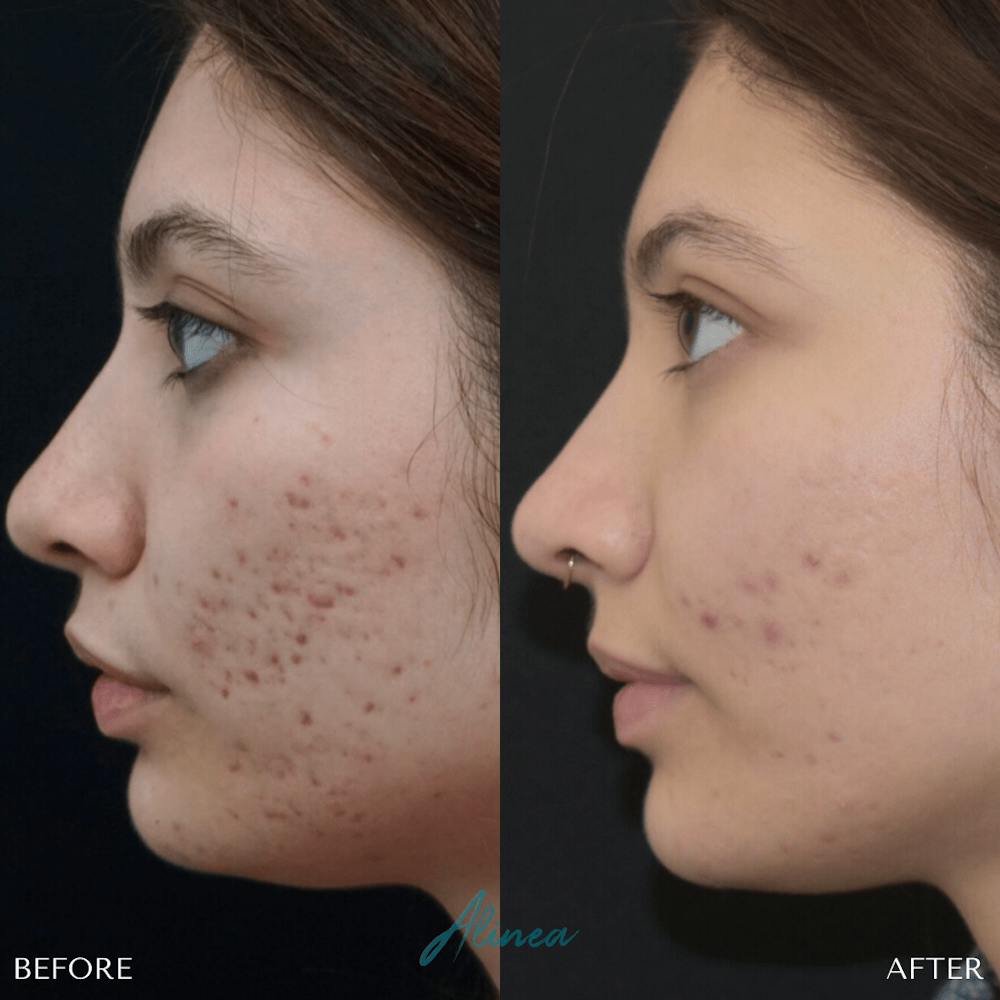 Acne Scars Before & After Gallery - Patient 20905116 - Image 1