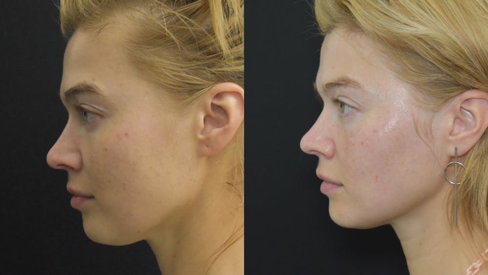 Profound RF Skin Tightening Before & After Gallery - Patient 122206133 - Image 1