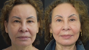 Before and after Profound skin tightening in NYC