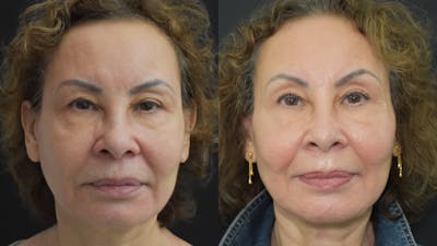 Profound RF Skin Tightening Before & After Gallery - Patient 122206135 - Image 1
