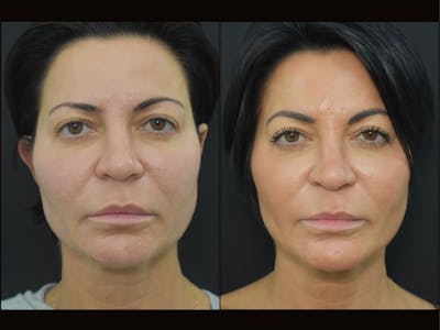 Profound RF Skin Tightening Before & After Gallery - Patient 122206134 - Image 1