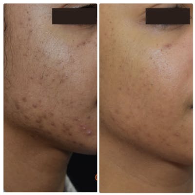 Acne Scars Before & After Gallery - Patient 122206997 - Image 1