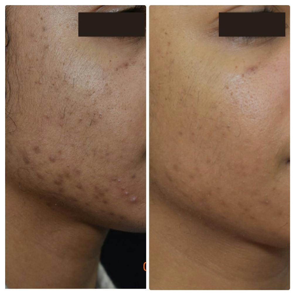 Acne Scars Before & After Gallery - Patient 122206997 - Image 1