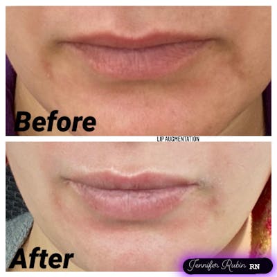 Fillers Before & After Gallery - Patient 122596979 - Image 1