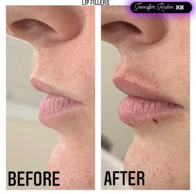 Fillers Before & After Gallery - Patient 122596980 - Image 1