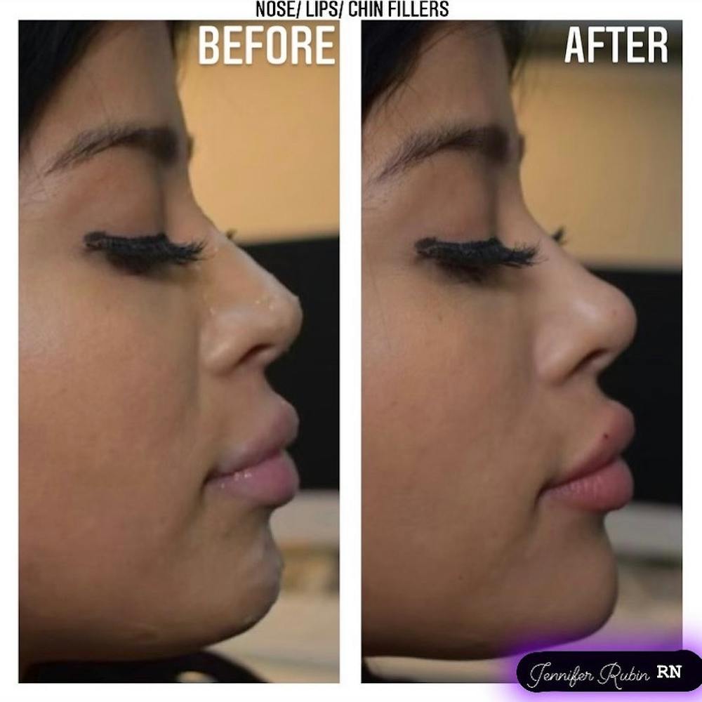 Fillers Before & After Gallery - Patient 122596981 - Image 1