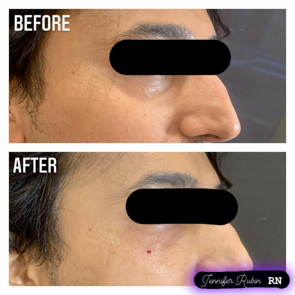 Fillers Before & After Gallery - Patient 122596982 - Image 1