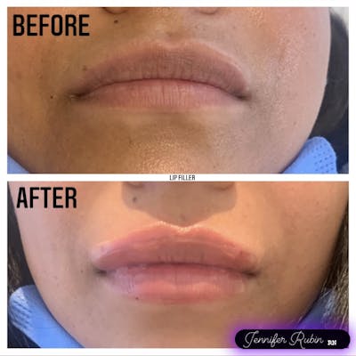 Fillers Before & After Gallery - Patient 122596983 - Image 1