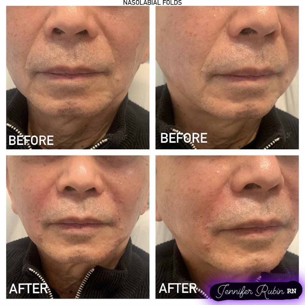 Fillers Before & After Gallery - Patient 122596984 - Image 1