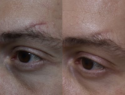 Acne Scars Before & After Gallery - Patient 149342178 - Image 1