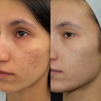 Acne Scars Before & After Gallery - Patient 149342177 - Image 1