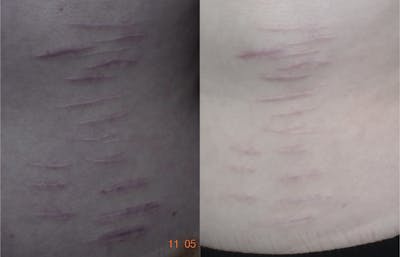Acne Scars Before & After Gallery - Patient 149342176 - Image 1
