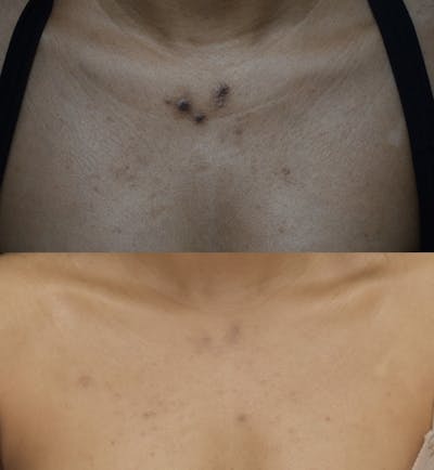 Acne Scars Before & After Gallery - Patient 149342166 - Image 1