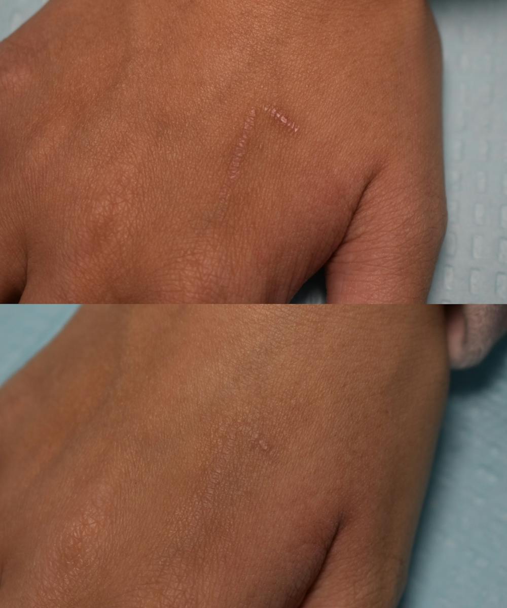 Acne Scars Before & After Gallery - Patient 149342167 - Image 1