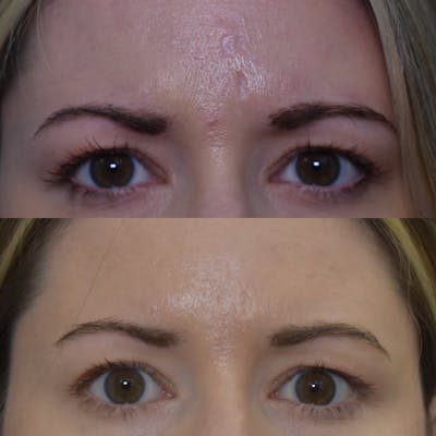 Acne Scars Before & After Gallery - Patient 149342168 - Image 1