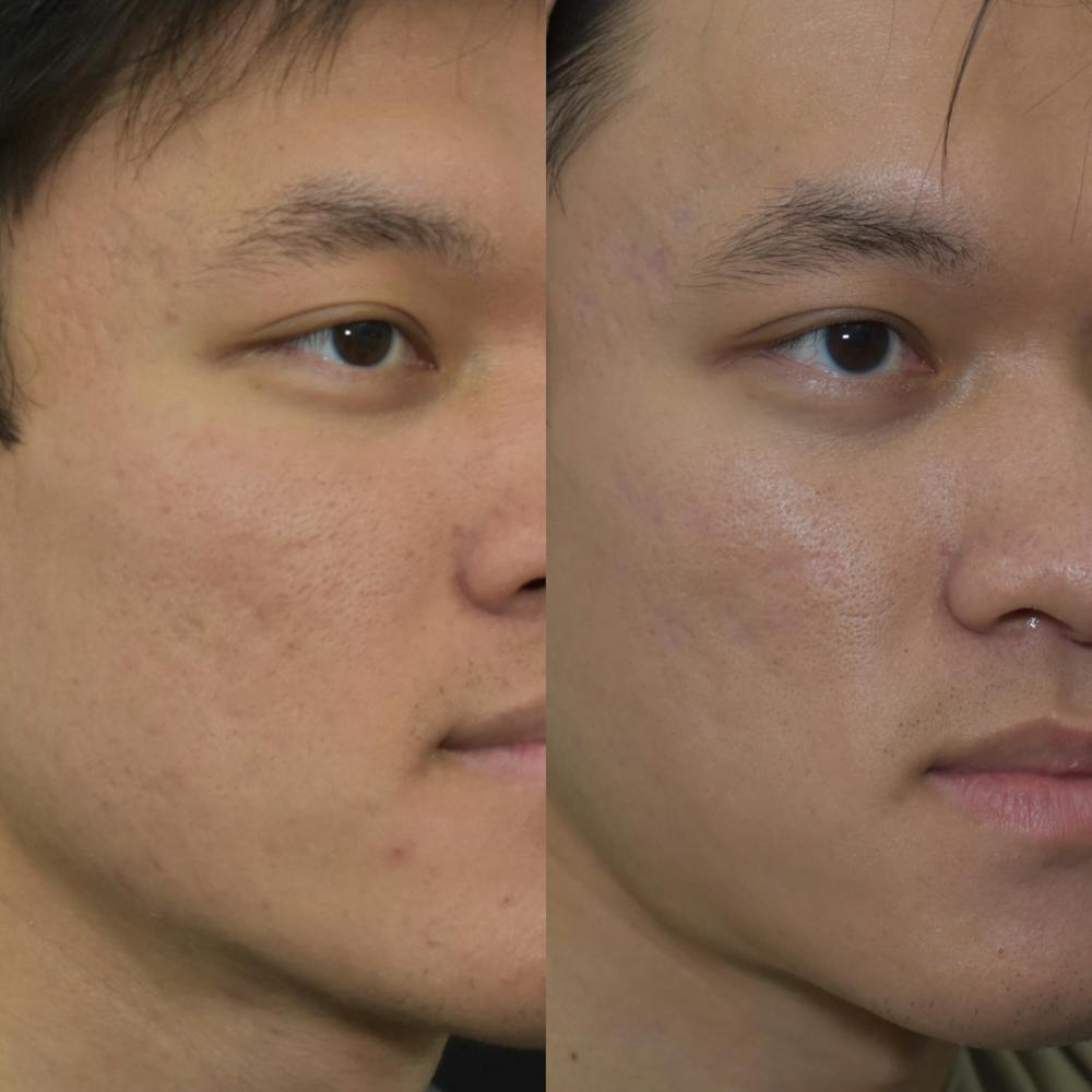 Acne Scars Before & After Gallery - Patient 149342169 - Image 1