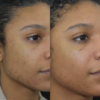 Acne Scars Before & After Gallery - Patient 149342170 - Image 1