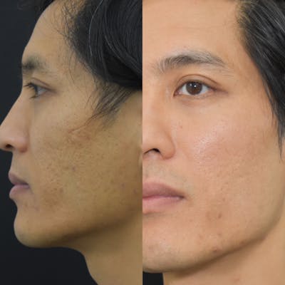 Acne Scars Before & After Gallery - Patient 149342171 - Image 1