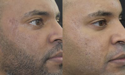 Acne Scars Before & After Gallery - Patient 149342172 - Image 1