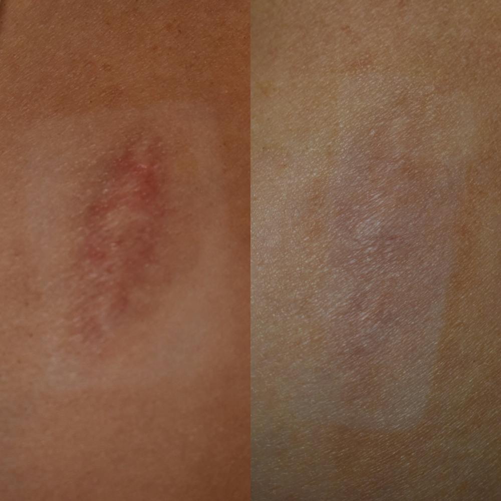 Acne Scars Before & After Gallery - Patient 149342175 - Image 1