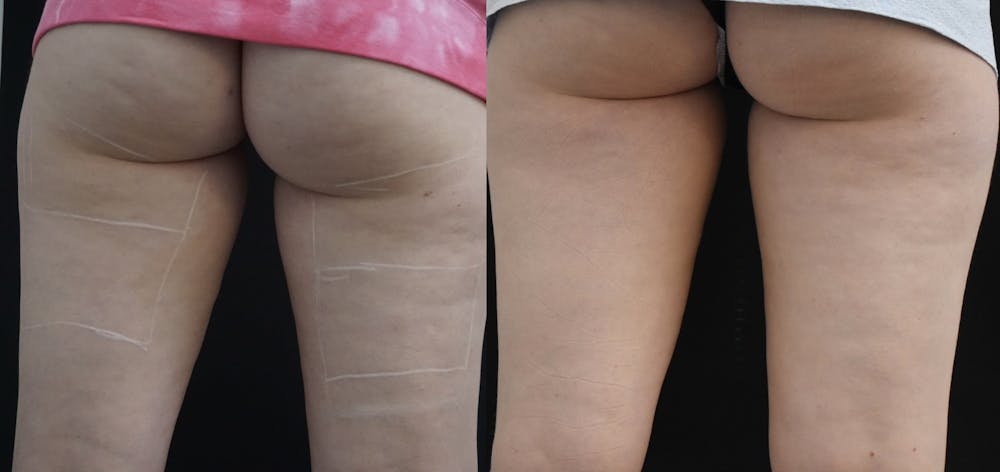 Profound RF Cellulite Before & After Gallery - Patient 149342187 - Image 1