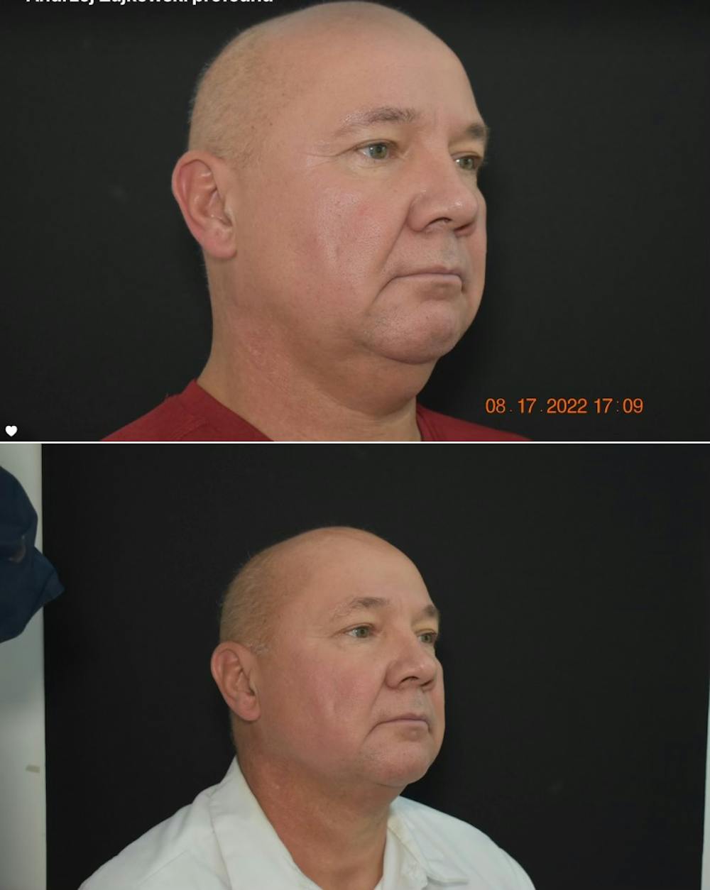 Profound RF Skin Tightening Before & After Gallery - Patient 149342196 - Image 1