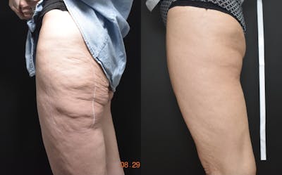 Profound RF Skin Tightening Before & After Gallery - Patient 149342195 - Image 1
