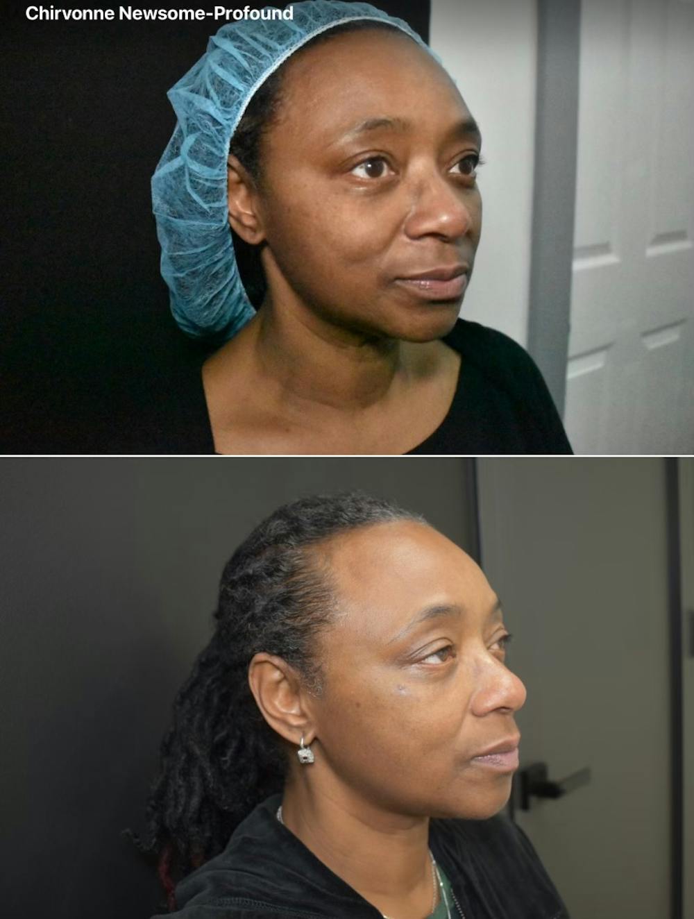 Patient 149342194  Profound RF Skin Tightening Before & After