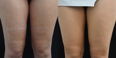 Profound RF Cellulite Before & After Gallery - Patient 149342186 - Image 1