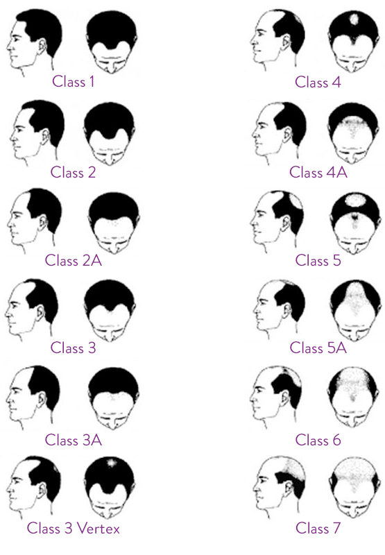 Stages of Hair Loss | Hair Transplantation Toronto