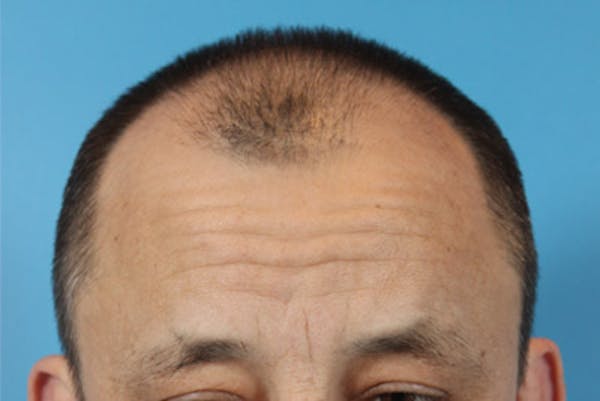 Hair Transplant Before & After Gallery - Patient 19340195 - Image 1