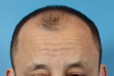 Hair Transplant Before & After Gallery - Patient 19340195 - Image 1