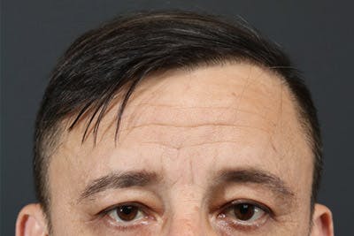Hair Transplant Before & After Gallery - Patient 19340195 - Image 2