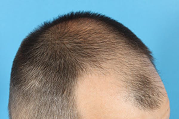 Hair Transplant Before & After Gallery - Patient 19340195 - Image 3