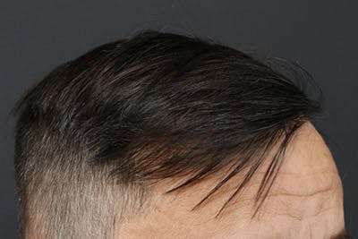 Hair Transplant Before & After Gallery - Patient 19340195 - Image 4