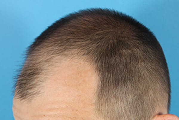 Hair Transplant Before & After Gallery - Patient 19340195 - Image 5
