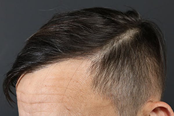 Hair Transplant Before & After Gallery - Patient 19340195 - Image 6