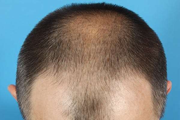 Hair Transplant Before & After Gallery - Patient 19340195 - Image 7