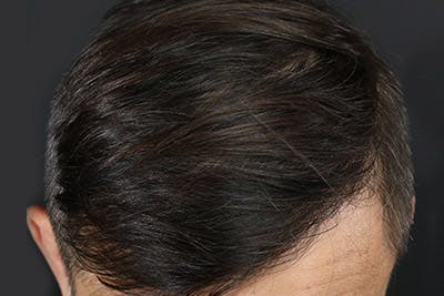 Hair Transplant Before & After Gallery - Patient 19340195 - Image 8