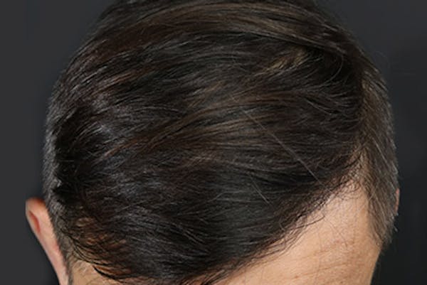 Hair Transplant Gallery - Patient 19340195 - Image 8