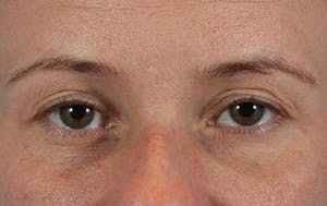 Eyebrow transplant before & after