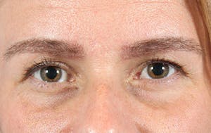 Eyebrow transplant before & after